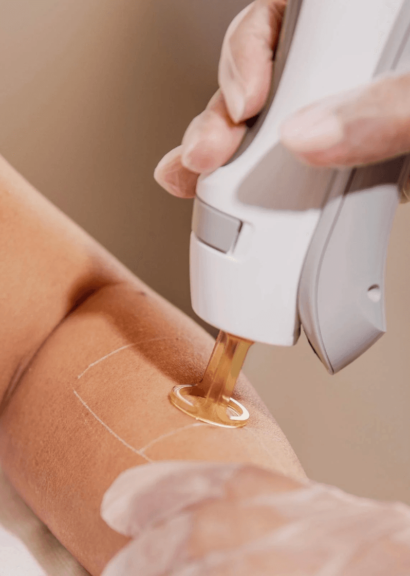 Laserontharing met de GentleMax Pro Plus: hoe werkt het en wat mag je verwachten? - 1